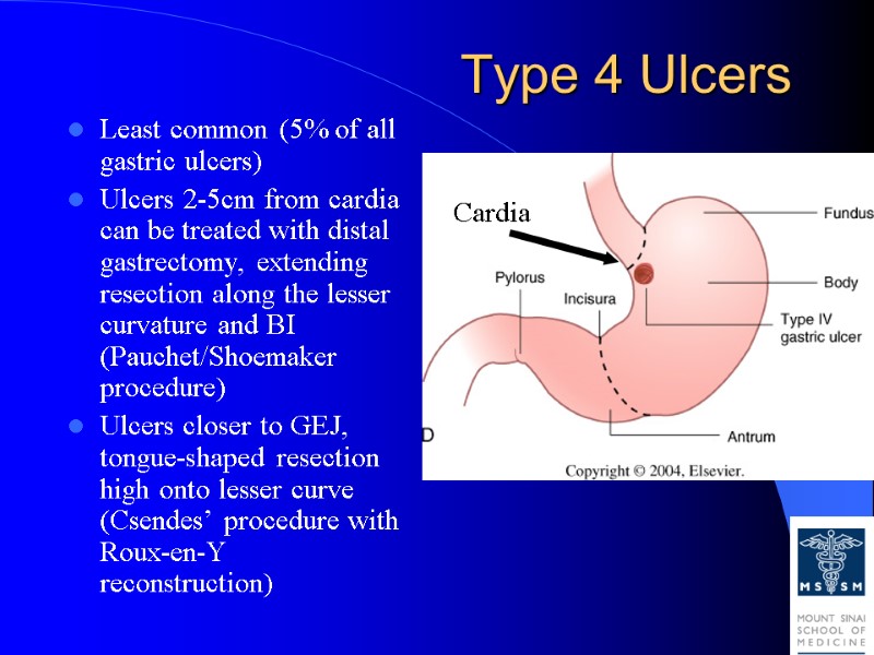 Type 4 Ulcers Least common (5% of all gastric ulcers) Ulcers 2-5cm from cardia